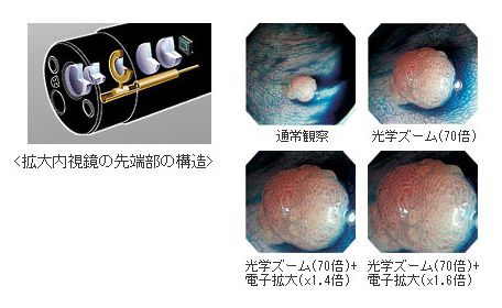 拡大内視鏡