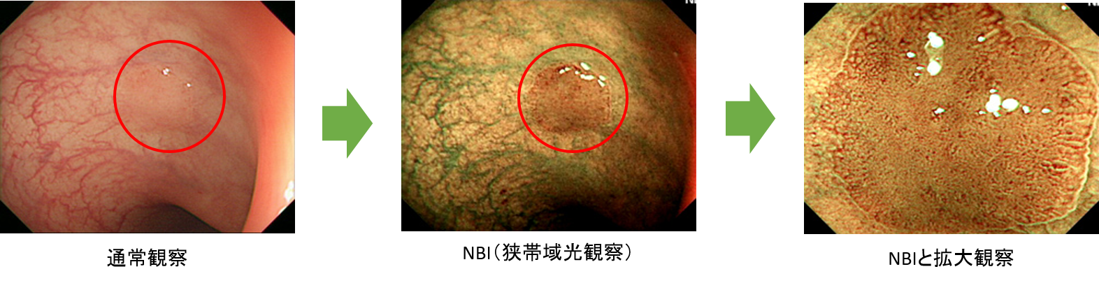NBIと拡大観察比較