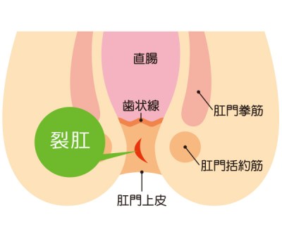 切れ痔