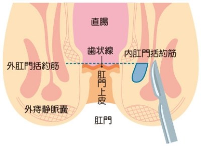 方 切れ 痔 治し