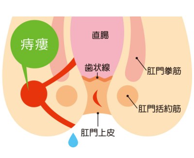 痔ろう