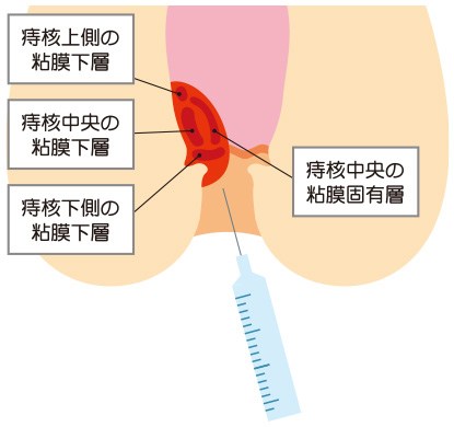 結紮切除術